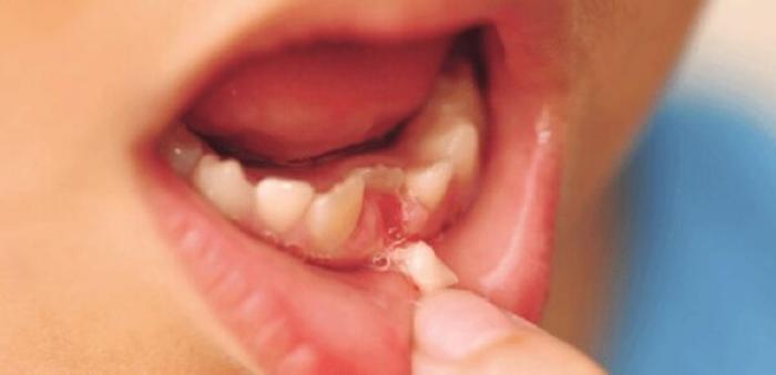 Nằm mơ thấy răng lung lay có ý nghĩa gì? 114451045