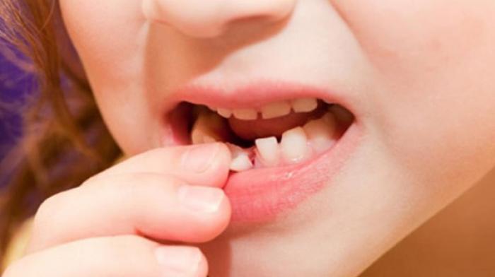 Nằm mơ thấy răng lung lay có ý nghĩa gì? 114451045