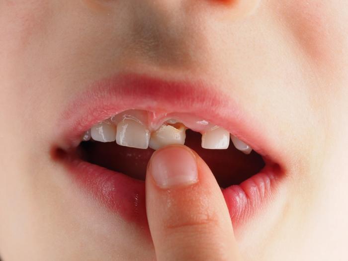 Nằm mơ thấy răng lung lay có ý nghĩa gì? 114451045