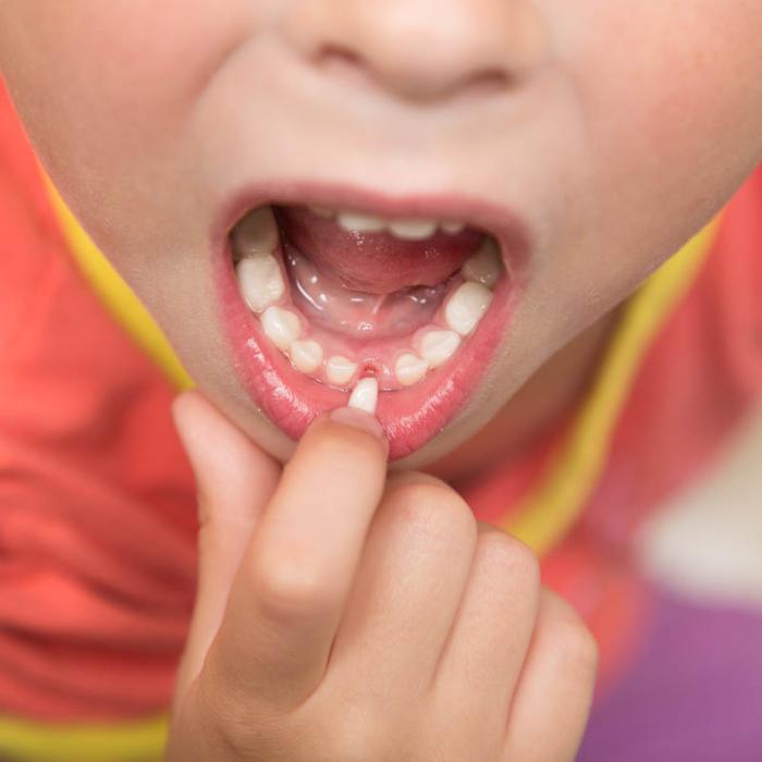 Nằm mơ thấy răng lung lay có ý nghĩa gì?