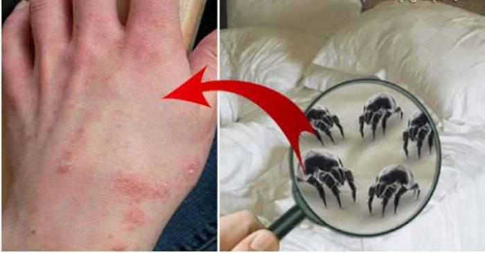 Làm sao để điều trị sùi mào gà dứt điểm và nhanh chóng?