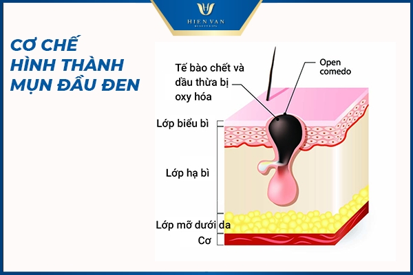 cơ chế hình thành mụn đầu đen